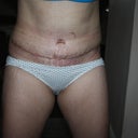 please bare in mind when you see this that it is only just 2 weeks old, this was taken after a bath, and I am showing this one as I believe the Surgeon did a fab job it is so clean and straight.....