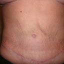up close of my scar and belly button almost 4 months post op