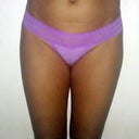 Sep 2012 Pre-op. No hips