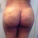 1 wk post op