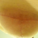 6 weeks post op, right (?) underboob