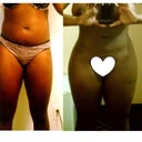 better picture of hips before and after (5 weeks after surgery)