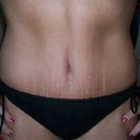 30 days PO:  Up close of my tummy!