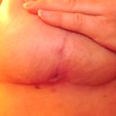 right breast is finally healing 7wks