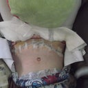 3 days post op.