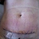 6 days post op