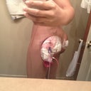 Post op pic