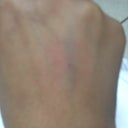 Yeah idk how this nurse missed my vein