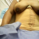 Right after surgery
