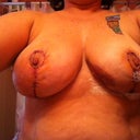 3 days post-op.  bruised and uneven.  there was some gauze stuck in the surgical glue-that's what is under the left nipple.