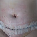 this is one week post op just had drains out.