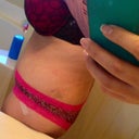 19 days PO, the little bruise on the side is not from Lipo its from my drain... I had one that part still aches but its not that bad