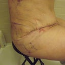 my side incision 2/2/13