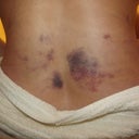 bruises from lipo....day 3