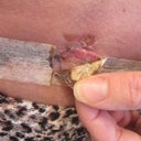 Day 19 Pus and skin loss around Scar.  Is this Necrosis?