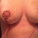One day post op