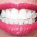 The 9th tray is approx 3 1/2 months time period.  You can see my teeth are already straighter.  I have to clean them again because the teeth that shifted show hidden tarter areas.