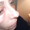 looking sideways onto right cheek (the better one) hah!
