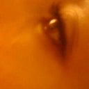 Left eye after