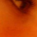 Right eye after
