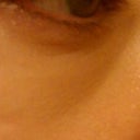 Right eye before