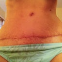 scar day 21