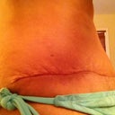 scar day 21, this side love handle is going down nicely.