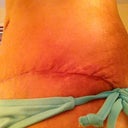 scar day 21