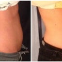 Left: Before.
Right: 8 weeks after one treatment of coolsculpting on abdomen and love handles/ flanks. As you may notice, pooch in the front of my belly is a little smaller and my tummy looks *fairly* flat.