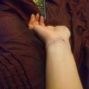 after excision (ten days after) still a bit of redness and blood.