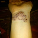 after the 9 laser sessions, still very visible.