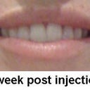 1 weeks after, they have gone down slightly but they still look fantastic!