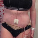 6 days post op