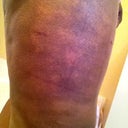 two days after cellulaze