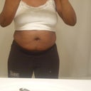 Pre-Op:  Front View 6/25/12 (7 days before op)