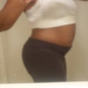 Pre-Op:  Side View 6/25/12 (7 days before op)