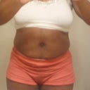 Pre-Op:  Front 6/25/12 (7 days before op)