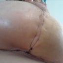 Close up of the double incision...on closer inspection i think its just where the stitches are pulled taught