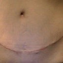 8 weeks.  Having dog ears and ends of scar lowered tomorrow in office.