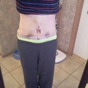 PO day 8 after shower and having binder off for about 30 minutes. See the super puff my left hip turns into?