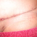 3 week's post-op doc said it looks awesome