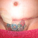 3 week's post-op doc said it looks awesome
