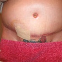 3 week's post-op doc said it looks awesome