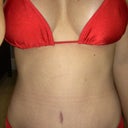 Same bikini, 60 days post op