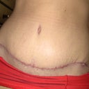 Close up of my incision, 60 days post op