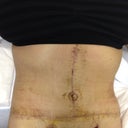 Just had the bandages removed.