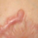 Upper Areola Scar