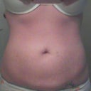 Tummy Tuck pre-surgery after weight loss