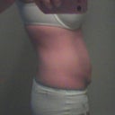 From the side tummy tuck pre-surgery