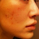 8 days after, last acne flare up cleared up quick but left with red marks and old scarring still